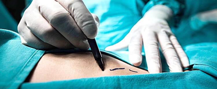 Liposuctie Liposuctie
