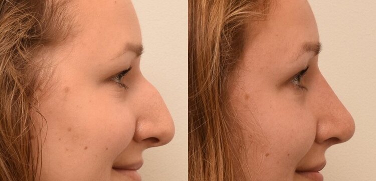 Rhinoplastie Rhinoplastie