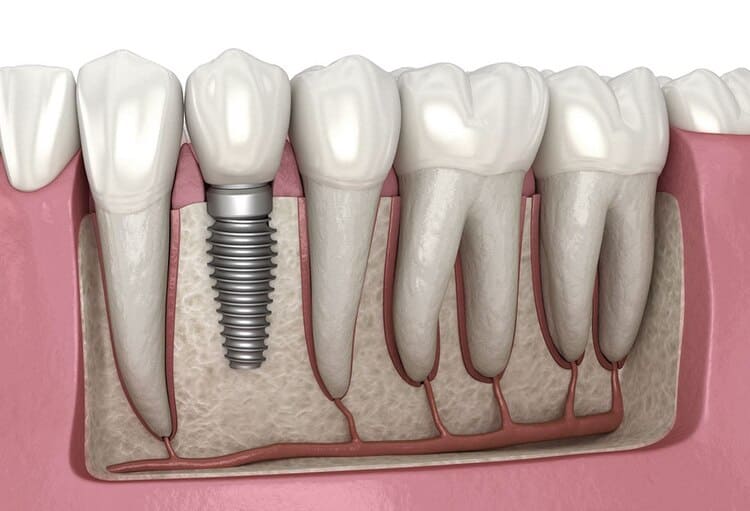 Een gids voor tandheelkundige implantaten